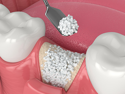 Advanced Dental Care of Las Colinas | Implant Dentistry, Root Canals and Fluoride Treatment