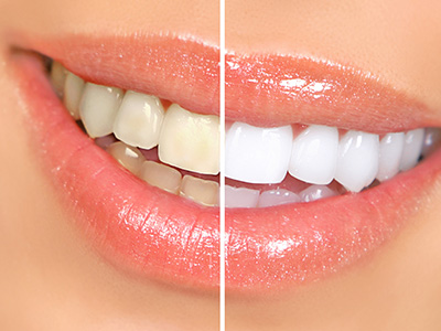 Advanced Dental Care of Las Colinas | Dental Bridges, Oral Cancer Screening and Sonicare Toothbrush