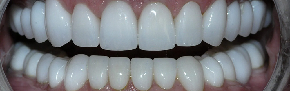 Advanced Dental Care of Las Colinas | Dental Bridges, Snoring Appliances and Oral Exams