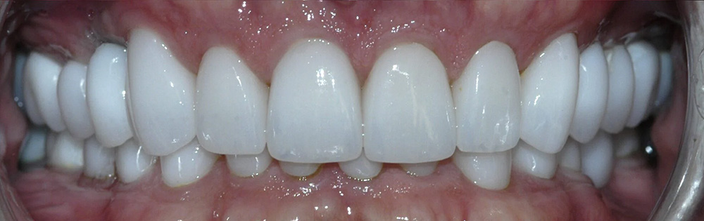 Advanced Dental Care of Las Colinas | Snoring Appliances, Dental Sealants and Dental Bridges