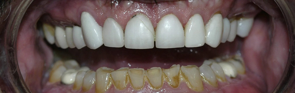Advanced Dental Care of Las Colinas | Dental Fillings, Night Guards and Emergency Treatment