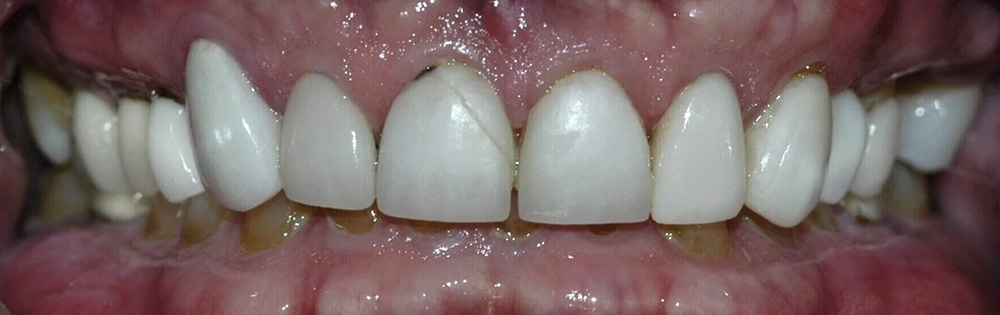 Advanced Dental Care of Las Colinas | Sedation Dentistry, Emergency Treatment and Crown Lengthening