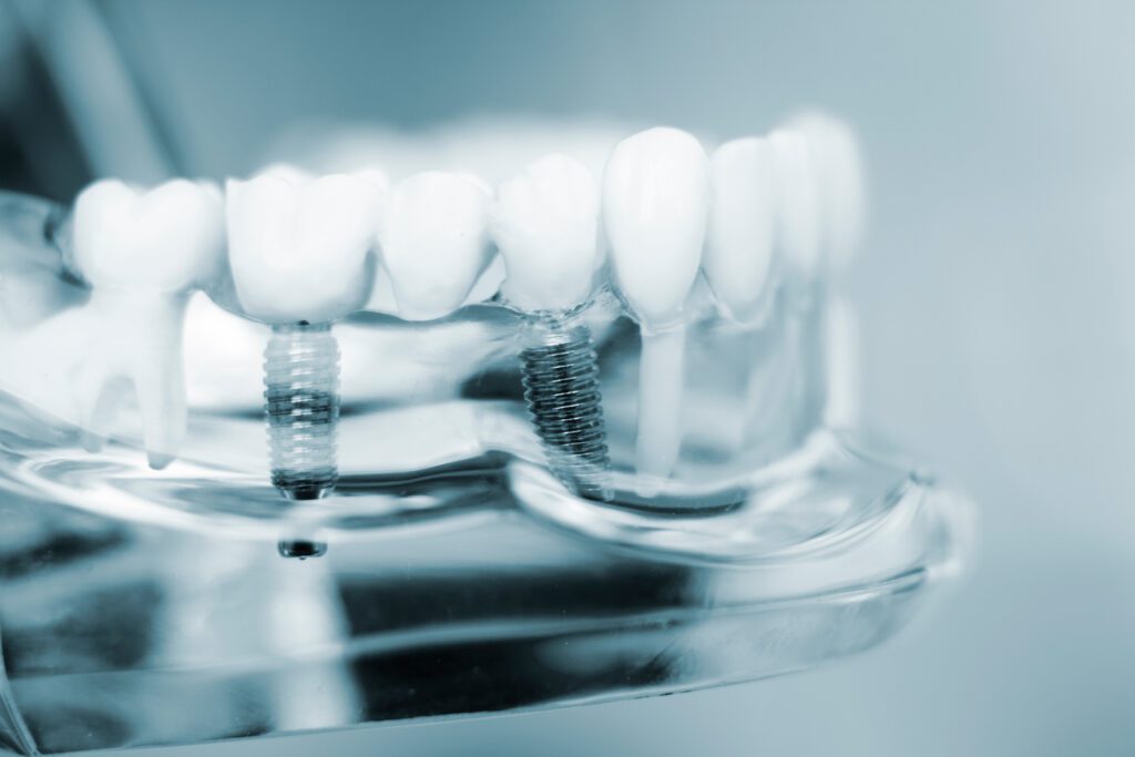 dental implants