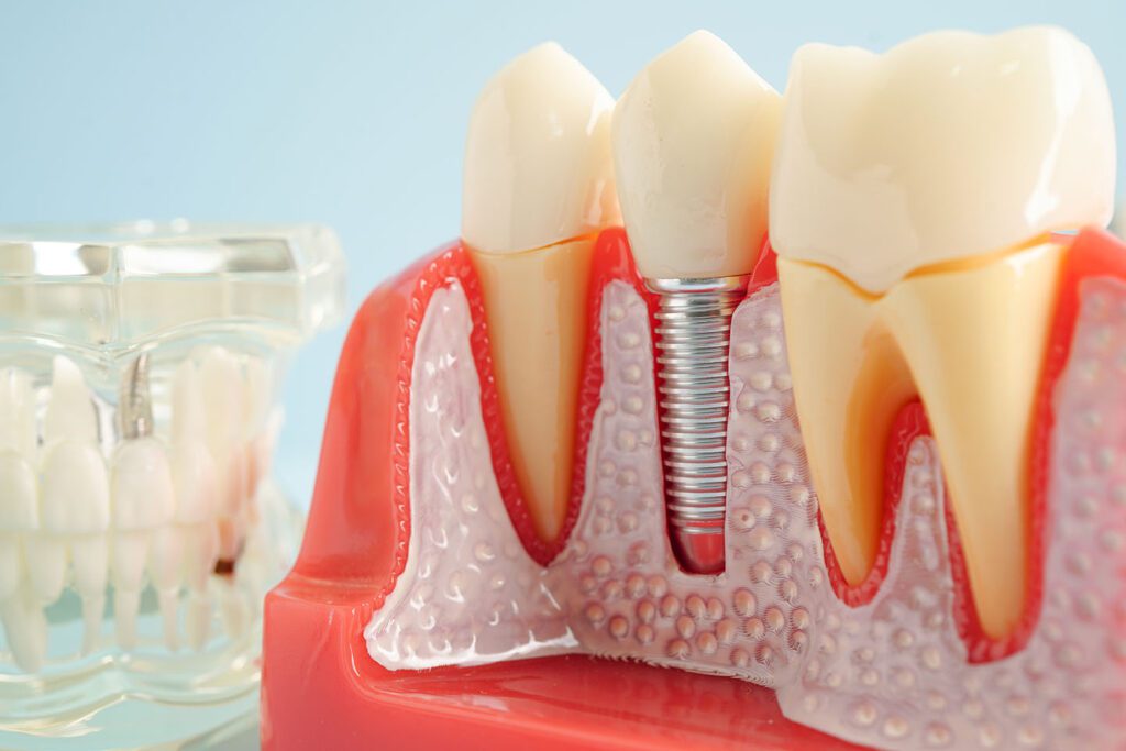 implant restoration dental implants dentist in Las Colinas